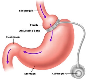 gastric-band