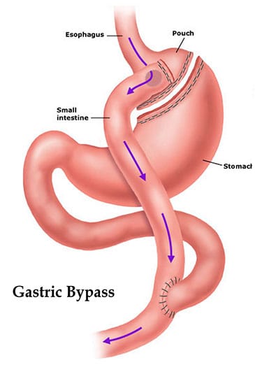 gastricbypass